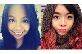 7 Singaporean Girls Share Their Plastic Surgery Experiences Zula Sg