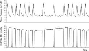 Verification of endotracheal intubation using a disposable end tidal co 2 detector (abstract). New Generation Continuous Cardiac Output Monitoring From Carbon Dioxide Elimination Bmc Anesthesiology Full Text