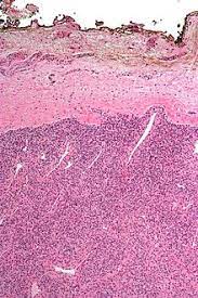 During or after surgery, a pathologist examines this rim of tissue — called the surgical margin or margin of resection — to be sure it's clear of any cancer cells. Resection Margin Wikipedia