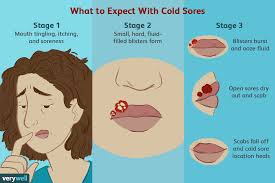How long does it take for a cold sore to heal? Cold Sore Outbreaks Causes Symptoms Stages Treatments