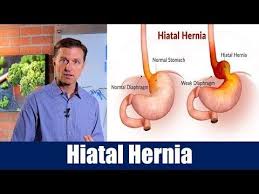 Possible causes, signs and symptoms, standard treatment the exact cause of a hiatal hernia is not known. Pin On Dr Eric Berg