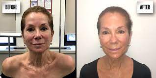 What Is Ultherapy Cost And Review Of The Mini Lift Without Surgery