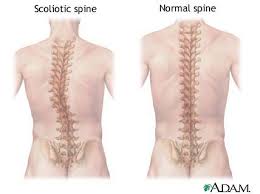 If you have scoliosis and are looking for exercises, start here. When Is The Right Time To Consider Scoliosis Surgery New Jersey Spine Specialists