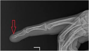 Image result for Glomus tumor