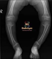 Image result for Rickets