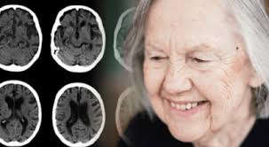 Cataract Surgery Archives