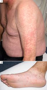 Image result for skin rash acute hiv infection
