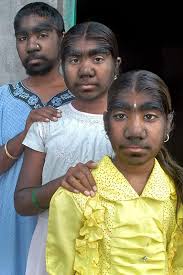 Meet The Werewolf Sisters Afflicted By Rare Genetic Mutation Gist By Bit Human Oddities Genetics Genetic Mutation