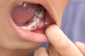 Image result for Periodontal Abscess