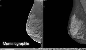 Wir erklären, ab wann eine mammographie zur früherkennung sinnvoll ist was macht man bei erblicher vorbelastung oder vorliegen einer genveränderung? Mammographie