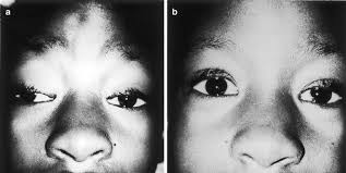 A free resource for physicians. Complex Ocular Motor Disorders In Children Springerlink