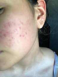 Okay so i want to get a discussion going about this because from my quick google search it seems a lot of people have this problem and no one really has the answer. How Can I Get Rid Of This Red Acne Marks I Only Have One Pimple As You Can See The Rest Are Just Bumps And Flat Marks Pie Acne