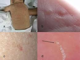 This infant with cystic fibrosis presented with perforation of the bowel and meconium peritonitis. Neonatal Skin Disorders Springerlink