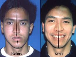 Image result for jaw surgery