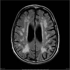 Cerebral Small Vessel Disease Radiology Reference Article Radiopaedia Org