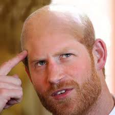 prince harry balding Fue hair ...
