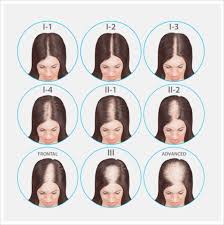 There are different types androgenetic alopecia/female pattern alopecia/female pattern hair loss (fphl)/baldness: Dr Pizarro Female Pattern Baldness