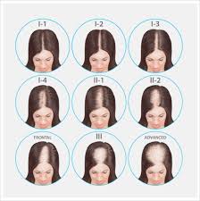 Hair thins mainly on the top and crown of the scalp. Dr Pizarro Female Pattern Baldness