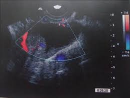 A doppler ultrasound is a quick, painless way to check for problems with blood flow such as deep vein thrombosis (dvt). Efficacy Of Color Doppler Ultrasonography In Differentiation Of Ovarian Masses Sehgal N J Mid Life Health
