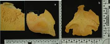 Image result for Craniotabes