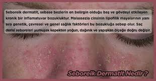 Seboreik dermatit bulaşıcı bir cilt hastalığı değildir. Seboreik Dermatit Nedir Izmirbotox