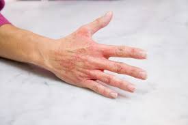 We did not find results for: Don T Let Hand Rashes Ruin Your Winter