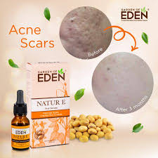 Sejak aku cuba pakai garden of eden rosa t tripple action acne serum ni, memang masalah jerawat tu berjaya ditangani. Garden Of Eden Natur E Scar Serum 5ml