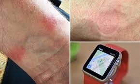 Can you get a rash from wearing a smartwatch? Apple Watch Wearers Share Photos Of Rashes Caused By Device On Twitter Daily Mail Online