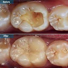 How long does it take to fill 3 cavities? Cavity Filling In Brooklyn Ny Dental Composite Fillings
