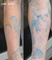 We offer a free consultation to determine the price per treatment as well as an estimate of how many treatments will be needed. Lasered Bio Coverup Sleeve Tattoo Tattoo Education