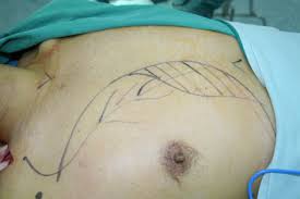 Research randomizer research randomizer random sampling and random assignment made easy! Extending The Arc Of Rotation Of The Pectoralis Major Myocutaneous Flap For Orofacial Reconstruction Via A Modified Subclavicular Route Through The Clavipectoral Fascia Journal Of Oral And Maxillofacial Surgery