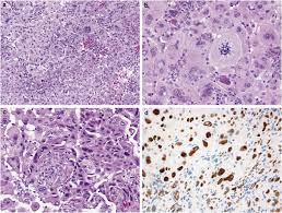 As like infiltration of the pleural lining mesothelioma is very painful and will lead you to the hospital right away. Pleomorphic Mesothelioma Report Of 10 Cases Modern Pathology