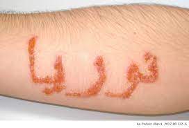 So it's surprising to know that henna body art is giving you rashes. Para Phenylenediamine Allergic Contact Dermatitis Due To Henna Tattoos In A Child And Adolescent Population Anales De Pediatria