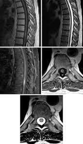 Partial transverse myelitis and partial myelitis are terms sometimes used to specify inflammation that only affects part of the width of the spinal cord. Transverse Myelitis The Neurosurgical Atlas