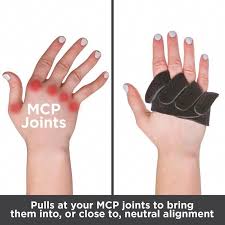 Ulnar Drift Splint Finger Deviation Brace Mcp Knuckle Arthritis Arthritistreatment Rheumatoid Arthritis Arthritis Symptoms Arthritis Treatment
