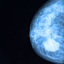 A tumor or lump will appear as a focused white area on the mammogram. Breast Cancer Symptoms Besides A Lump Signs Of Breast Cancer