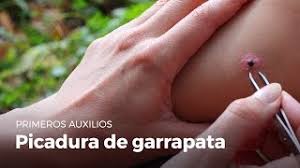 Check spelling or type a new query. Primeros Auxilios Picadura De Garrapata Youtube