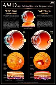 eye wall charts age related macular degeneration amd