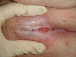 Du skriver ikke noe om hvor lang tid du har behandlet deg mot soppinfeksjonen. Lichen Sclerosus Et Atrophicus Nhi No