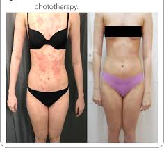 Assessment Of Patients With Psoriasis Undergoing Treatment With Narrowband Uvb Phototherapy In The State University Of Para Brazil Semantic Scholar