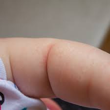 How to get rid of armpit irritation / armpit rashes? Treating A Rash In Skin Folds Thriftyfun