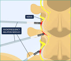 Image result for Radiofrequency Surgery