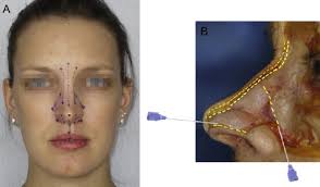 Rhinoplastie et injection de tissu adipeux autologue