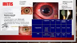 Image result for Ciliary Flush