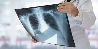 Tb test cost without insurance. Tuberculosis Test Tb Ppd Skin Test Passport Health