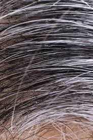 In spanish the nouns come before description so it would be: White Hair Causes And Ways To Prevent It