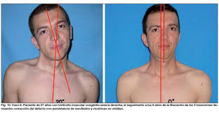 En la tortícolis se produce una distonía o contractura mantenida de los músculos del cuello, habitualmente del esternocleidomastoideo, aunque también puede estar afectado el trapecio, los escalenos, o el angular de la escápula. Torticolis Muscular Congenita Punto De Vista Del Cirujano Plastico