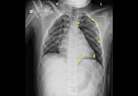 Image result for Pneumothorax