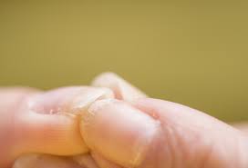 Vitamin a is fat soluble and the body just takes what it needs and. Hypervitaminosis A Symptoms Causes And Treatment