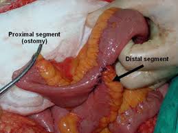 Image result for Enterostomy